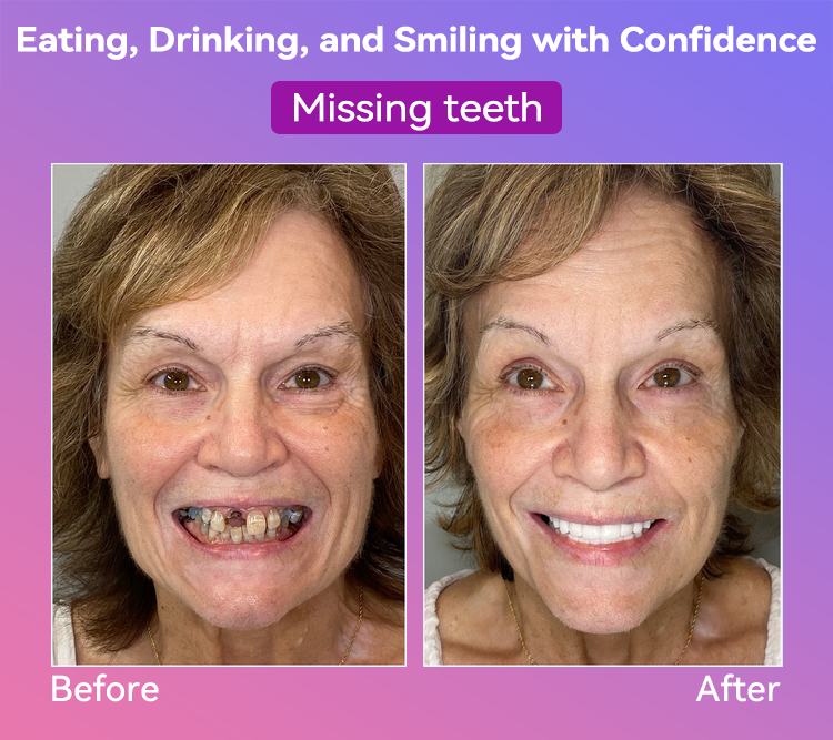 𝐉𝐚𝐬𝐬𝐞𝐞𝐦® Latest Premium Comfort Dentures🎉 (High-End Dentures, Easy to Wear - Limited Time 70% Discount)🔥