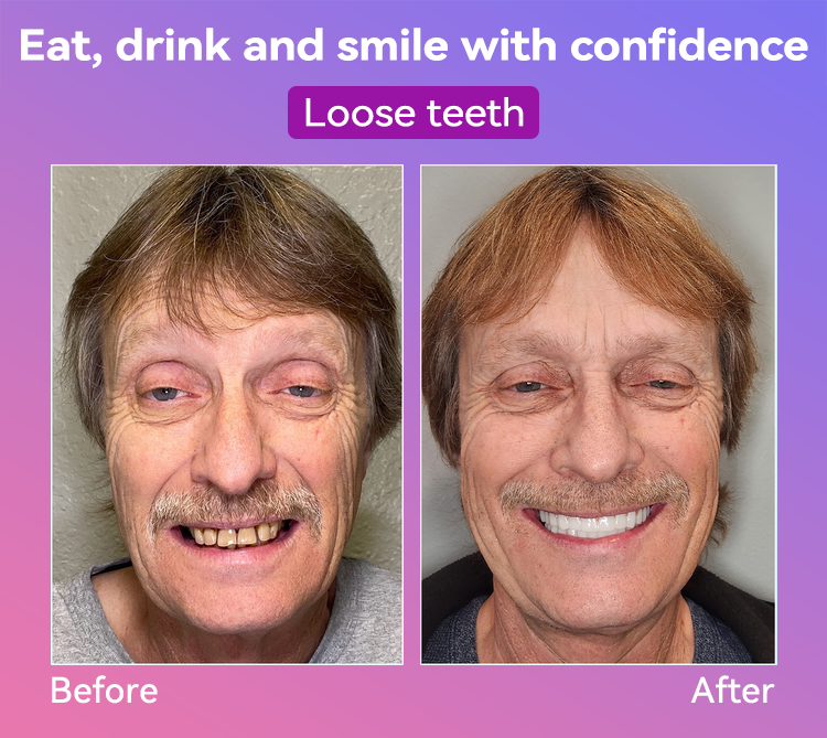 𝐉𝐚𝐬𝐬𝐞𝐞𝐦® Latest Premium Comfort Dentures🎉 (High-End Dentures, Easy to Wear - Limited Time 70% Discount)🔥