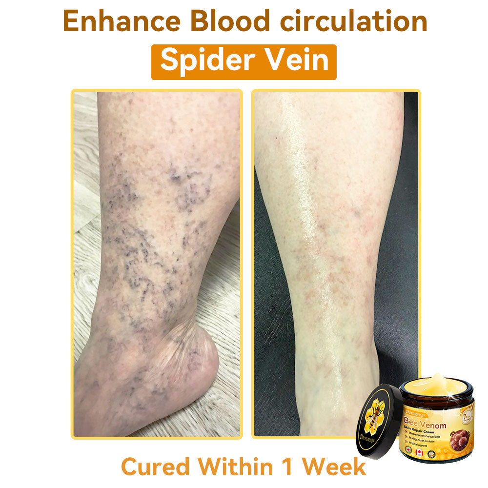 𝐃𝐨𝐫𝐦𝐨𝐫𝐧𝐚®💧Bee Venom Repair Cream (Anti-aging, deep hydration, skin repair, even skin tone, acne and dark spot treatment, removal of warts and moles, and psoriasis relief)