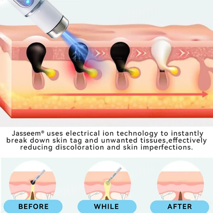 𝐉𝐚𝐬𝐬𝐞𝐞𝐦® Medical-Grade Laser Pen 💕 (Powered by CO₂ laser technology – effectively removes moles, warts, skin tags, pigmentation spots, and other skin imperfections)🔥