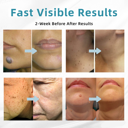 𝐉𝐚𝐬𝐬𝐞𝐞𝐦® Medical-Grade Laser Pen 💕 (Powered by CO₂ laser technology – effectively removes moles, warts, skin tags, pigmentation spots, and other skin imperfections)🔥
