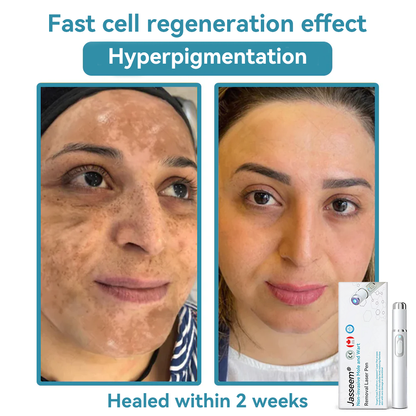 𝐉𝐚𝐬𝐬𝐞𝐞𝐦® Medical-Grade Laser Pen 💕 (Powered by CO₂ laser technology – effectively removes moles, warts, skin tags, pigmentation spots, and other skin imperfections)🔥