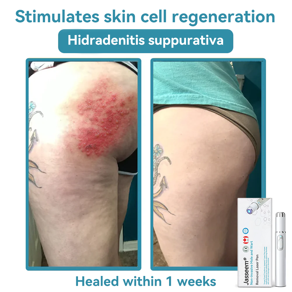 𝐉𝐚𝐬𝐬𝐞𝐞𝐦® Medical-Grade Laser Pen 💕 (Powered by CO₂ laser technology – effectively removes moles, warts, skin tags, pigmentation spots, and other skin imperfections)🔥