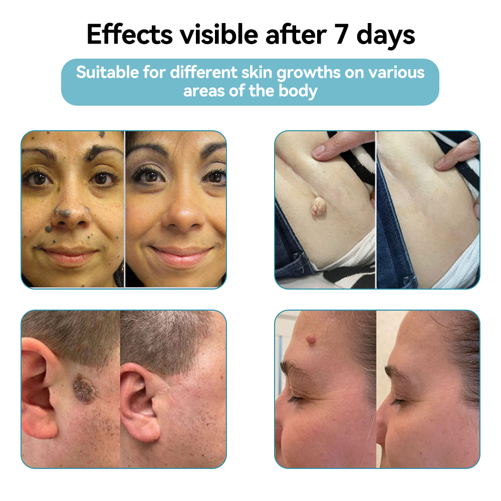 𝐉𝐚𝐬𝐬𝐞𝐞𝐦® Medical-Grade Laser Pen 💕 (Powered by CO₂ laser technology – effectively removes moles, warts, skin tags, pigmentation spots, and other skin imperfections)🔥