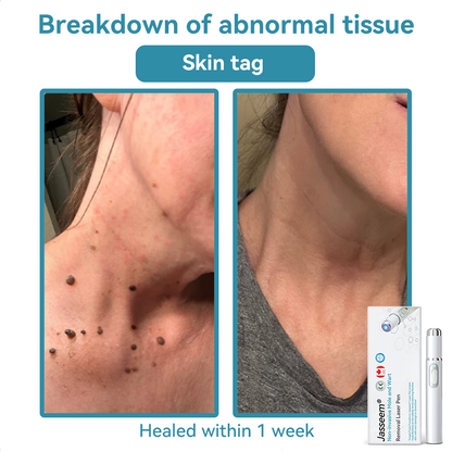 𝐉𝐚𝐬𝐬𝐞𝐞𝐦® Medical-Grade Laser Pen 💕 (Powered by CO₂ laser technology – effectively removes moles, warts, skin tags, pigmentation spots, and other skin imperfections)🔥