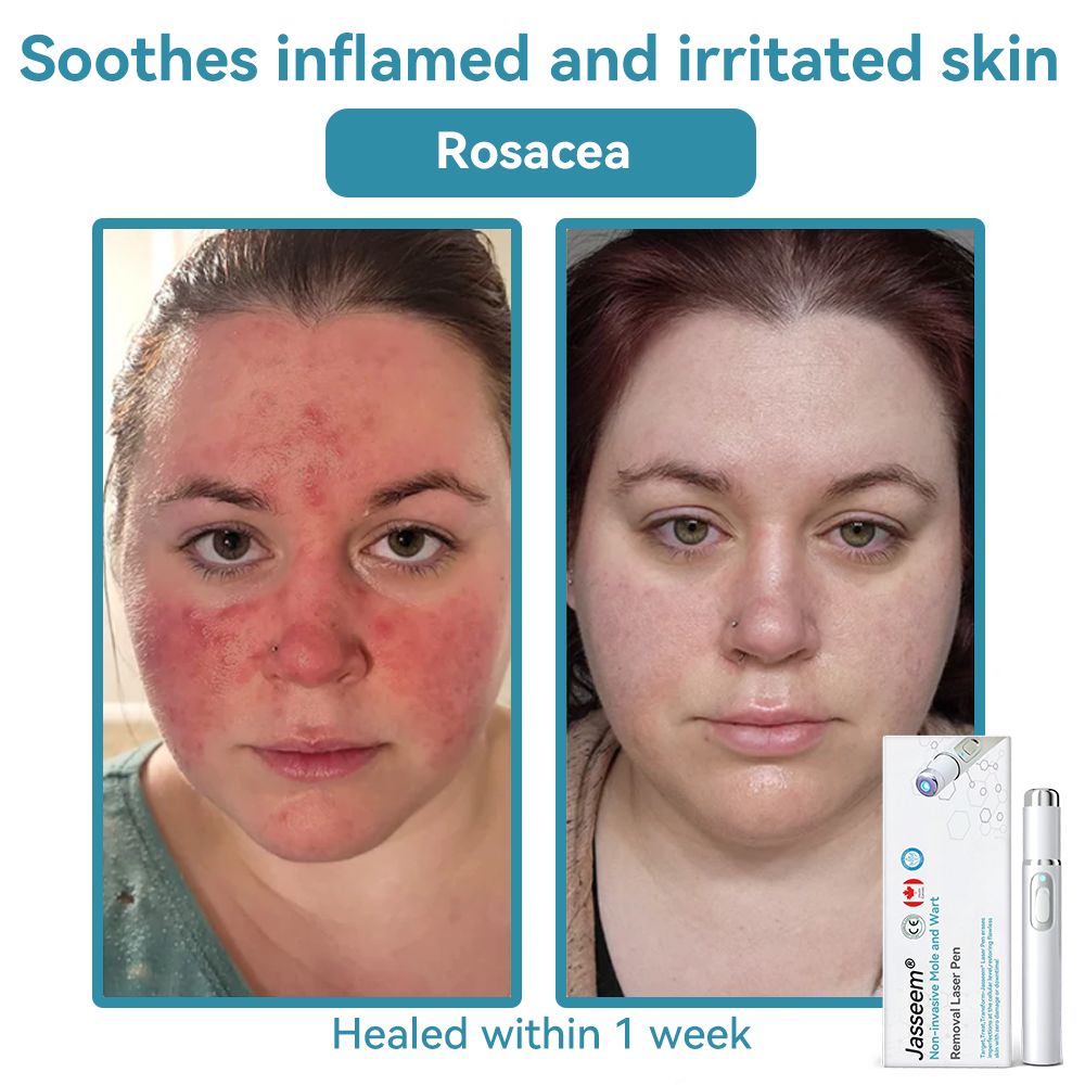 𝐉𝐚𝐬𝐬𝐞𝐞𝐦® Medical-Grade Laser Pen 💕 (Powered by CO₂ laser technology – effectively removes moles, warts, skin tags, pigmentation spots, and other skin imperfections)🔥